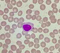 CLL with intracytoplasmic inclusions 3