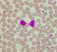 CLL with intracytoplasmic inclusions 4