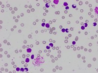 Cytoplasmic inclusions in CLL lymphocytes 5