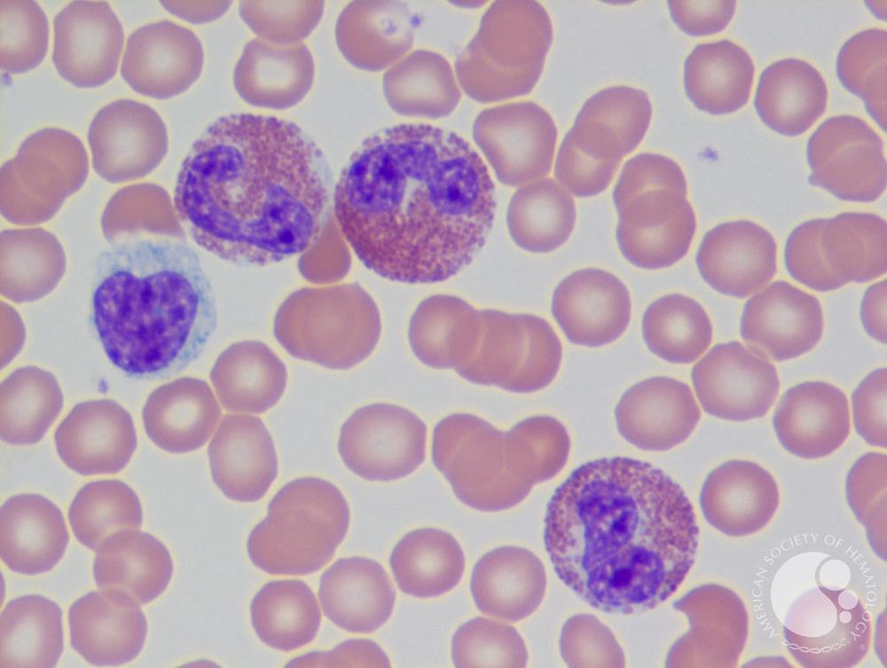 Eosinophils and lymphocyte