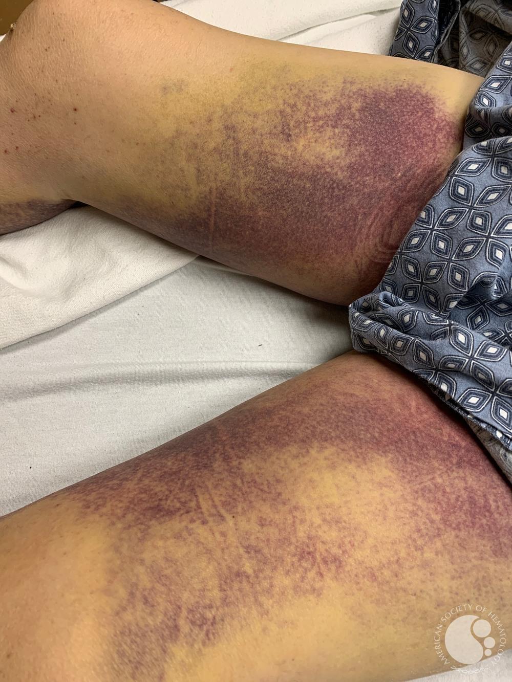 Spontaneous bruising in a middle aged male