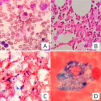 Gaucher's disease: Cytochemical diagnosis