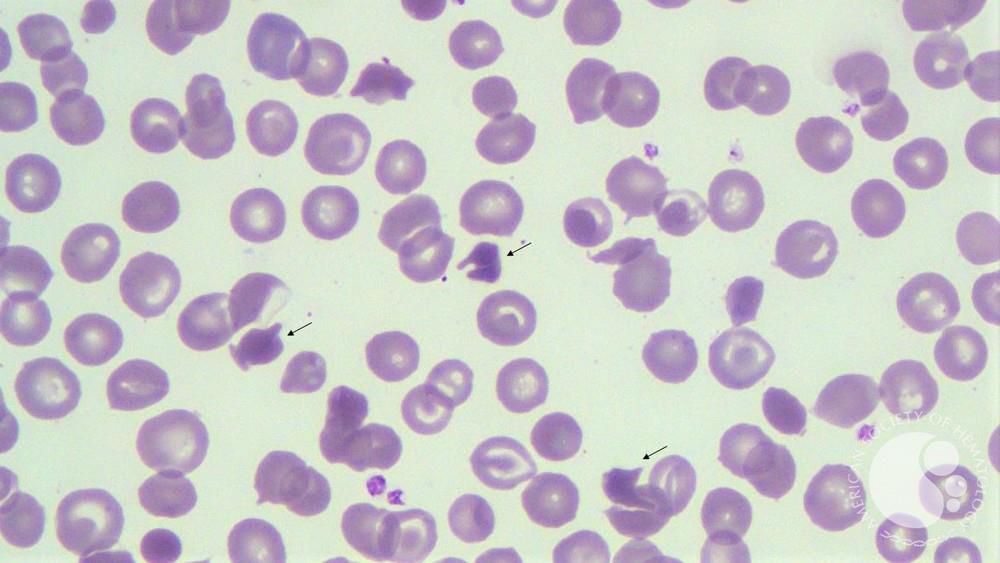 Hemoglobin SC disease