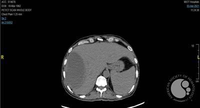 CT Abdomen - Liver Abscess