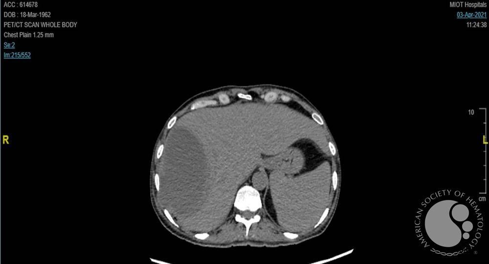 CT Abdomen - Liver Abscess
