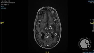 Nocardia Brain Abscess - MRI Brain