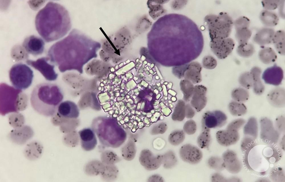 Macrophage with cystine crystals