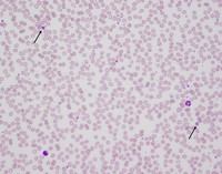 Myelodysplastic syndrome with del(5q)