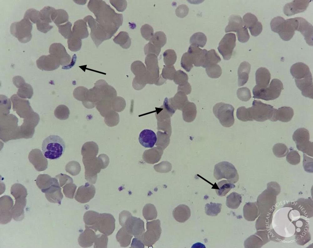 Malaria: Gametocyte of Plasmodium Falciparum