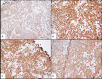 Myeloid Sarcoma immunostains