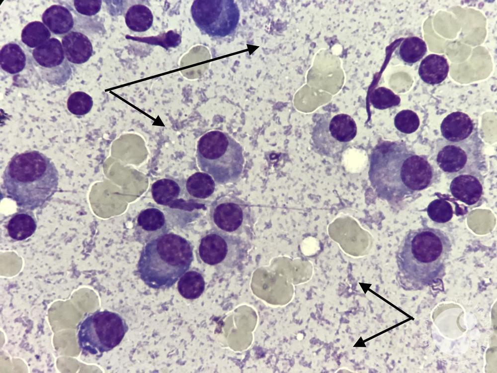 Cryoglobulins in a patient with Multiple Myeloma