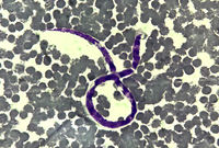 Microfilaria of Wuchereria bancrofti
