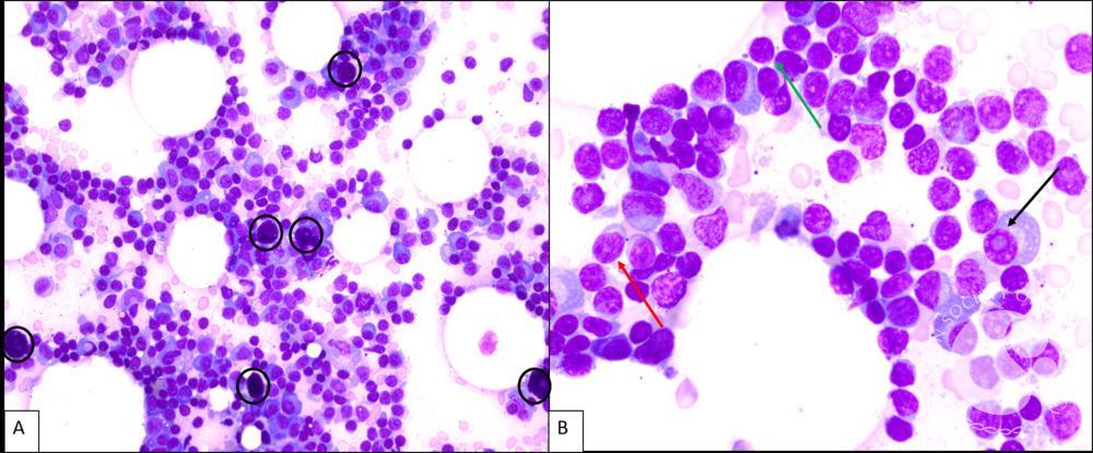 Lymphoplasmacytic lymphoma - Bone marrow aspirate