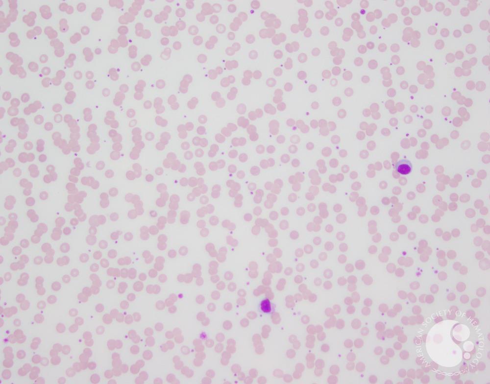 Lymphoplasmacytic lymphoma - Peripheral blood