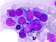 plasmablastic lymphoma