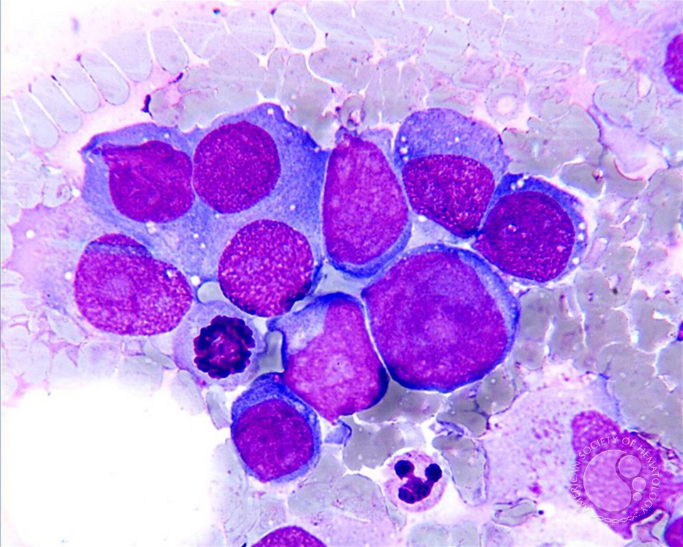 plasmablastic lymphoma