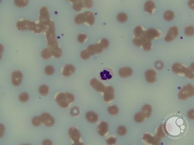 Bluish background staining in multiple myeloma peripheral blood film 1