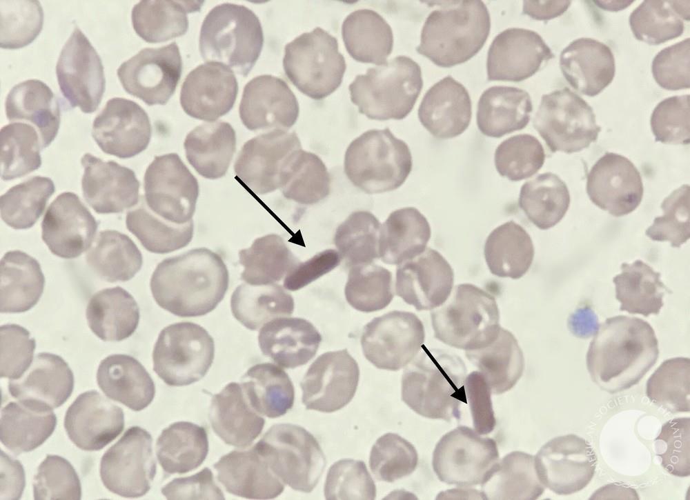 Hemoglobin C Crystals