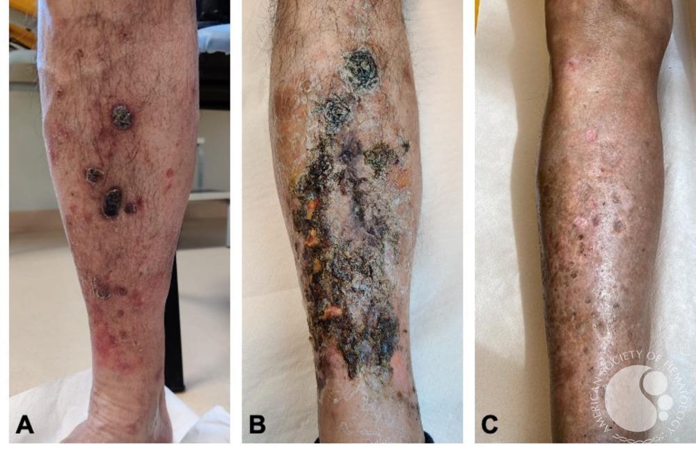 Primary cutaneous CD8+ epidermotropic cytotoxic T-cell lymphomas, a rare and dramatic challenge still open