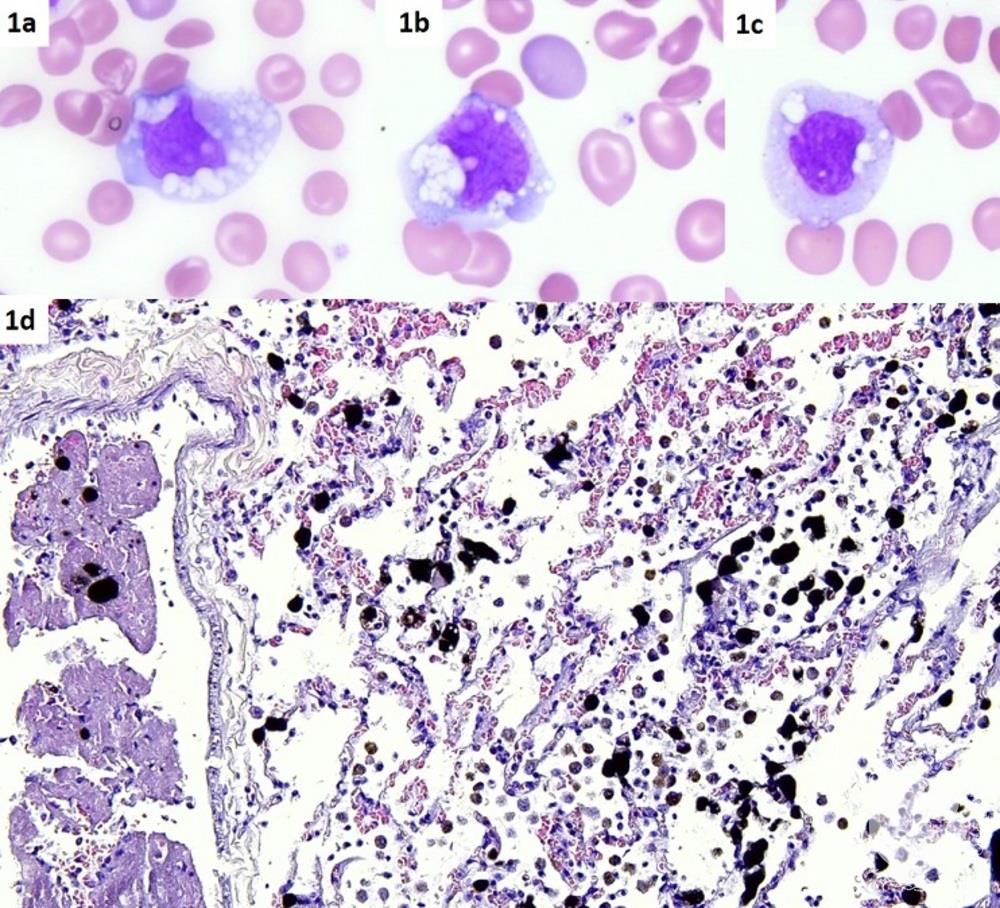 Lipid-laden Monocytes in Peripheral Blood of a Patient with Hemoglobin SC Disease in Crisis