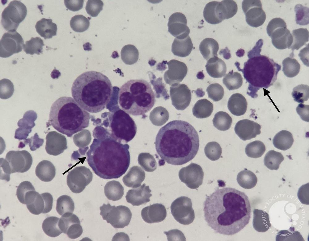 Acute Megakaryoblast Leukemia