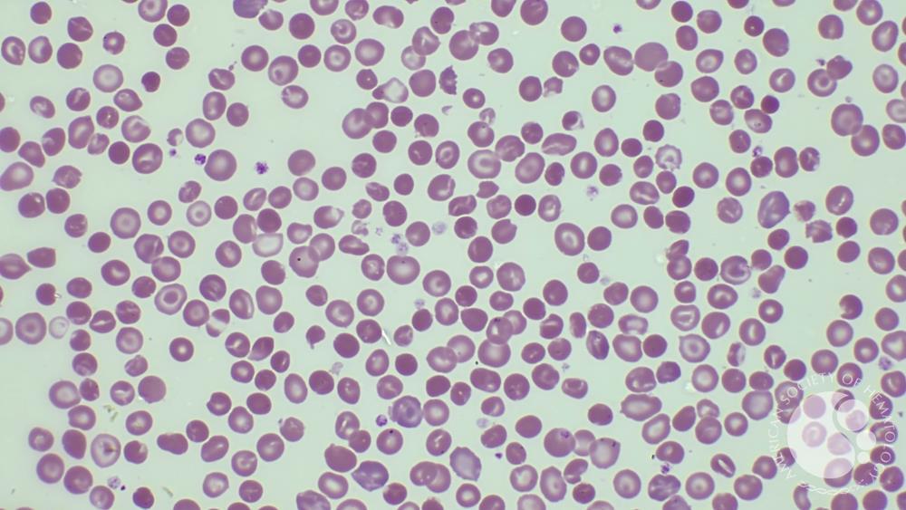 Hemoglobin C disease