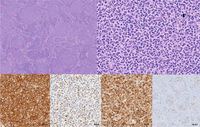 Follicular lymphoma