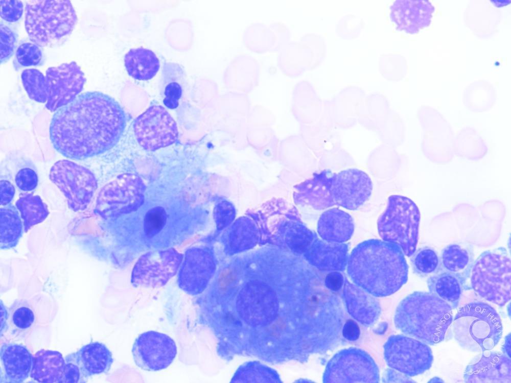 Figure c. Bone marrow aspirate smear 100X, Giemsa stain showing Gaucher like cell in AML.