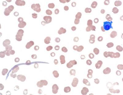 Immunoglobulin Crystals in Plasma Cell Leukemia 1