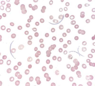 Immunoglobulin Crystals in Plasma Cell Leukemia 2