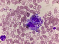 Hemophagocytosis 3
