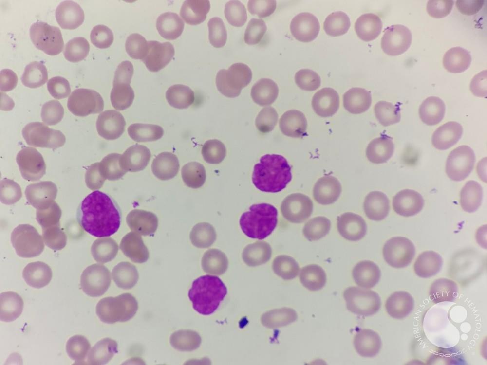 peripheral smear showing atypical lymphoid cells