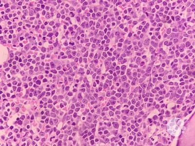 Bone marrow biopsy-infiltration by large lymphoid  cells with prominent eosinophilic nucleoli