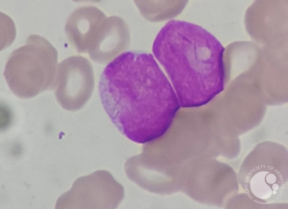 AML with cup shaped blats