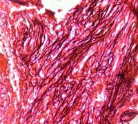 Grade 3 reticulin fibrosis in PMF