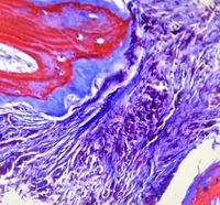 Para- trabecular collagen apposition in PMF