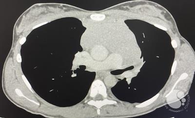 T-ALL chest CT