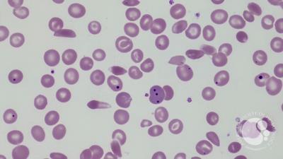 Sickle cell anemia with functional hyposplenism 1