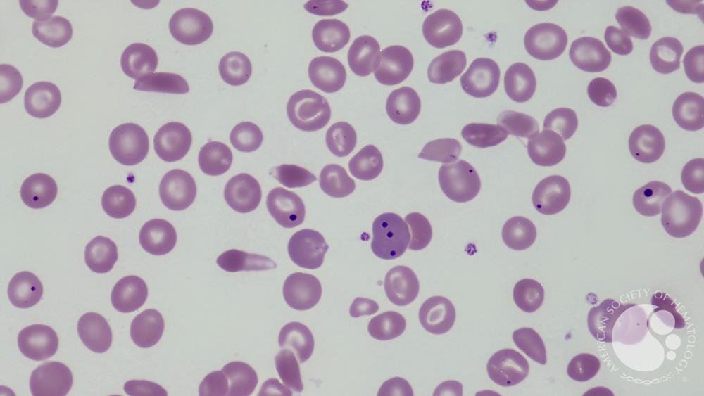 Sickle cell anemia with functional hyposplenism 1