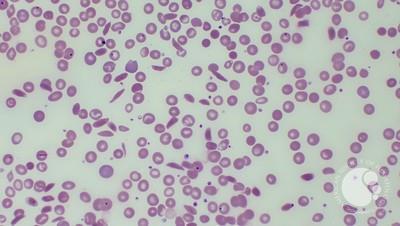 Sickle cell anemia with functional hyposplenism 2