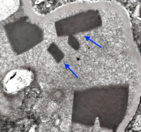 Intraluminal Crystals