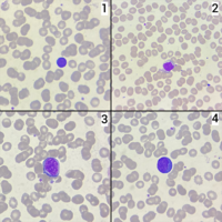 Reactive lymphocyte types