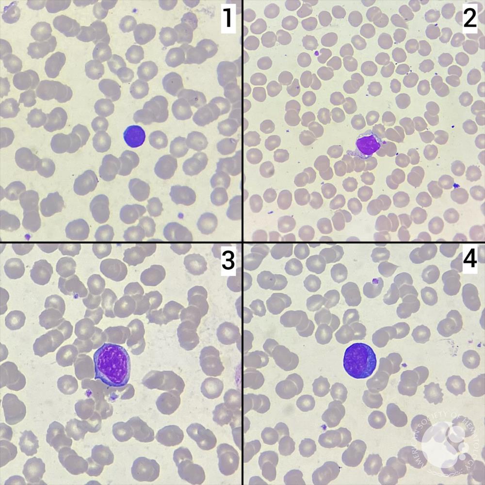 Reactive lymphocyte types