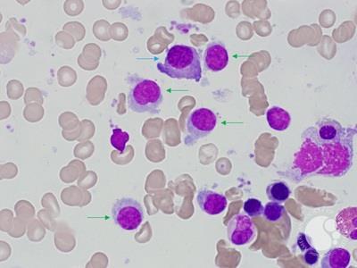 Hairy Cell Leukaemia and Multiple Myeloma 1