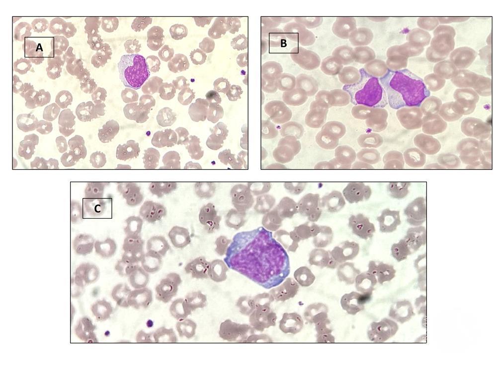 Downey Cells in Infectious Mononucleosis: Decoding the Role of Lymphocyte Abnormalities in Diagnosis