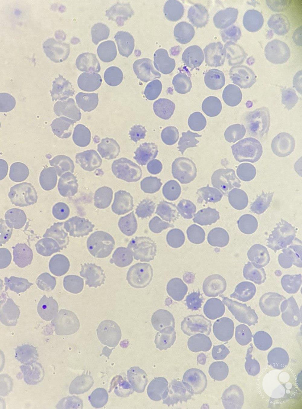 beta-thalassemia major