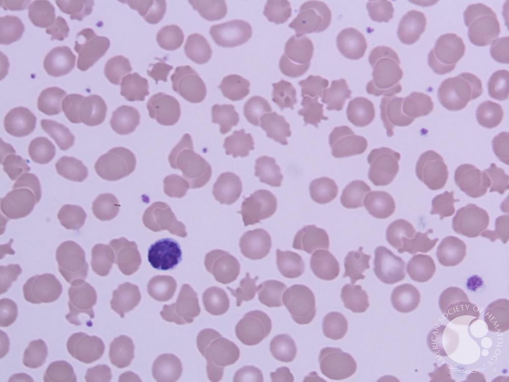 Peripheral smear 100X, Leishman Stain showing multiple acanthocytes