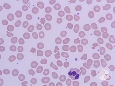 Peripheral smear 100X, Leishman Stain showing multiple acanthocytes along with one Eosinophil