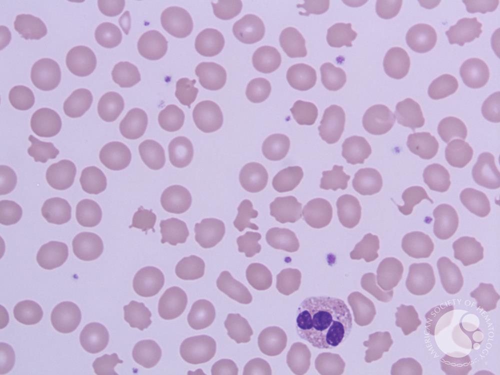 Peripheral smear 100X, Leishman Stain showing multiple acanthocytes along with one Eosinophil