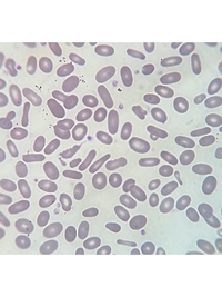Hereditary Elliptocytosis